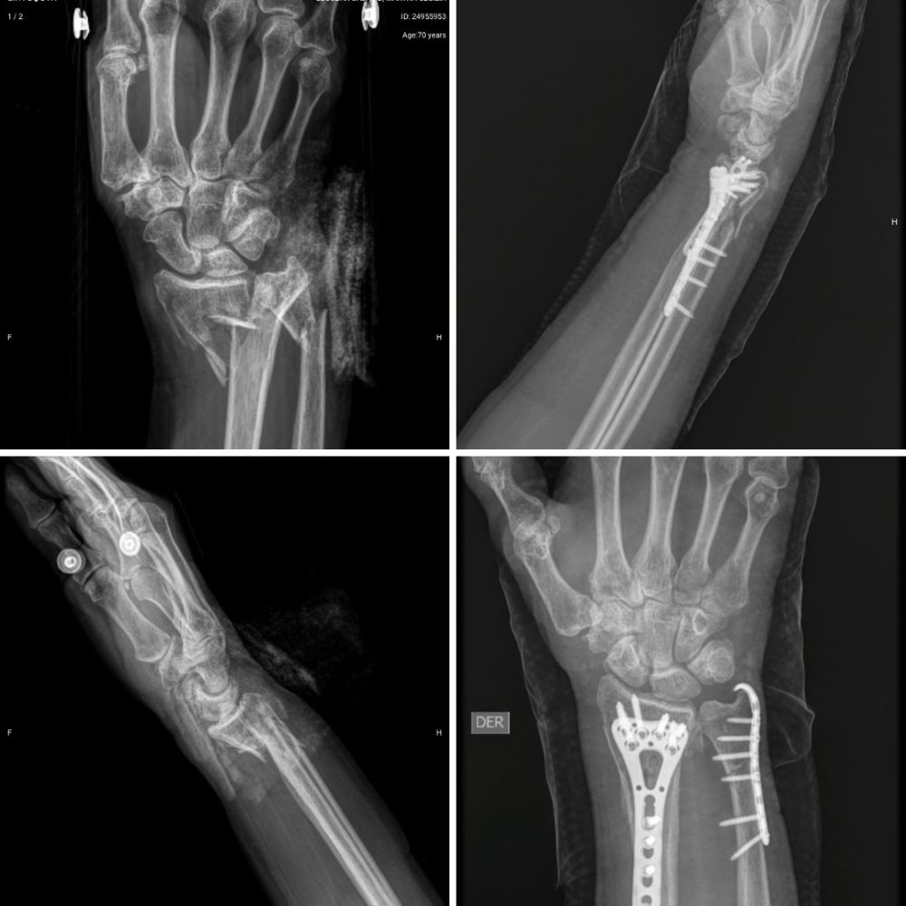 Trauma-Cirugía de mano y miembro superior cirujanos en Pereira